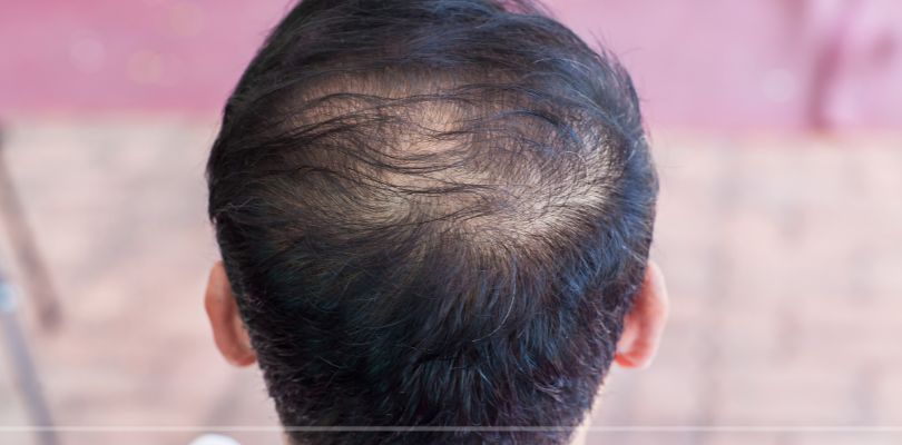 worst foods for hair loss